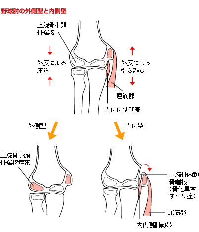 野球肘2