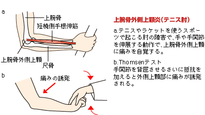 テニス肘