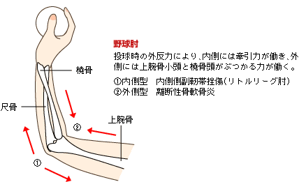 野球肘