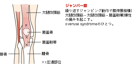 ジャンパー膝