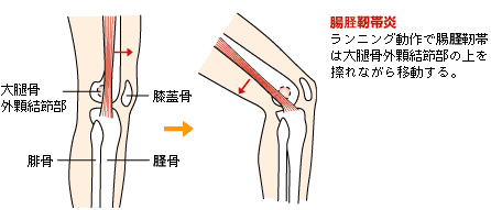 ランナー膝イメージ