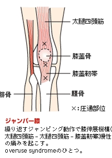 ジャンパー膝イメージ